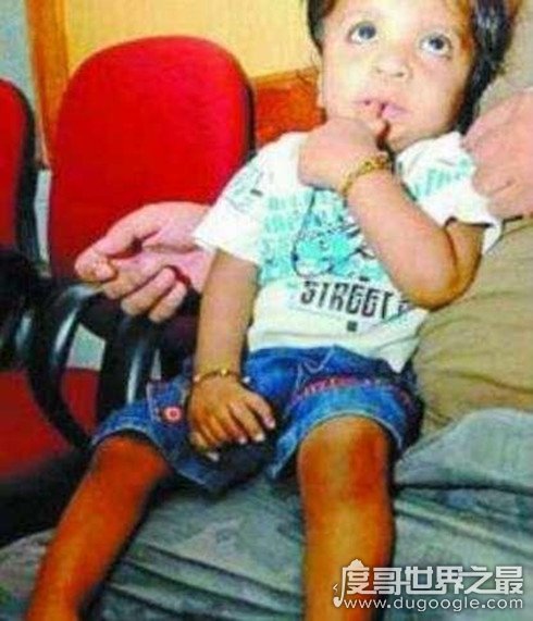世界上手指最多的人現身印度，長有7根手指
