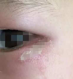 隱翅蟲咬了多久痊愈