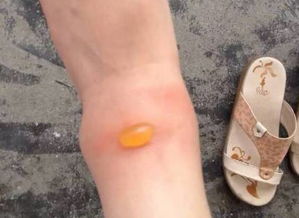 隱翅蟲爬過后會留疤嗎