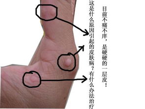 渦蟲怎么清除