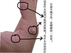 渦蟲怎么清除