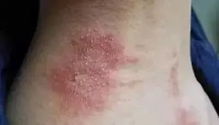 隱翅蟲爬過的地方有毒嗎