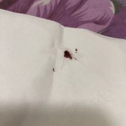 如何辨別是否被床虱咬
