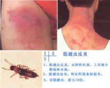 如何預防隱翅蟲
