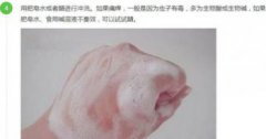 身上被毒蟲咬了怎么辦