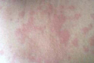 毒蟲咬了腫了怎么辦