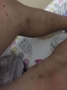 家里有隱翅蟲怎么辦