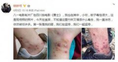 林妙可被毒蟲咬傷照片，觸目驚心腳腕全是傷痕