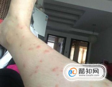 螨蟲咬的包是啥樣子，怎么判斷是不是螨蟲咬的
