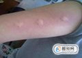 被花蚊子咬了怎么辦，被蚊子咬了怎么幽默回復