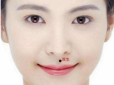 雙生痣是什么意思，一般就是指人中有痣